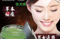 治疗脸部痤疮最有效的口服药