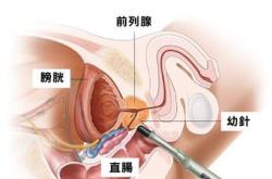 前列腺增生能喝茶叶