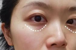 眼部细纹如何改善
