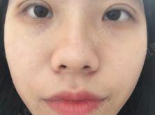 眼睛肿茶叶可以消肿吗