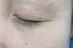 怎样去除眼部皱纹最有效