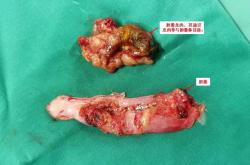 胆囊息肉患者是否可以喝红酒？